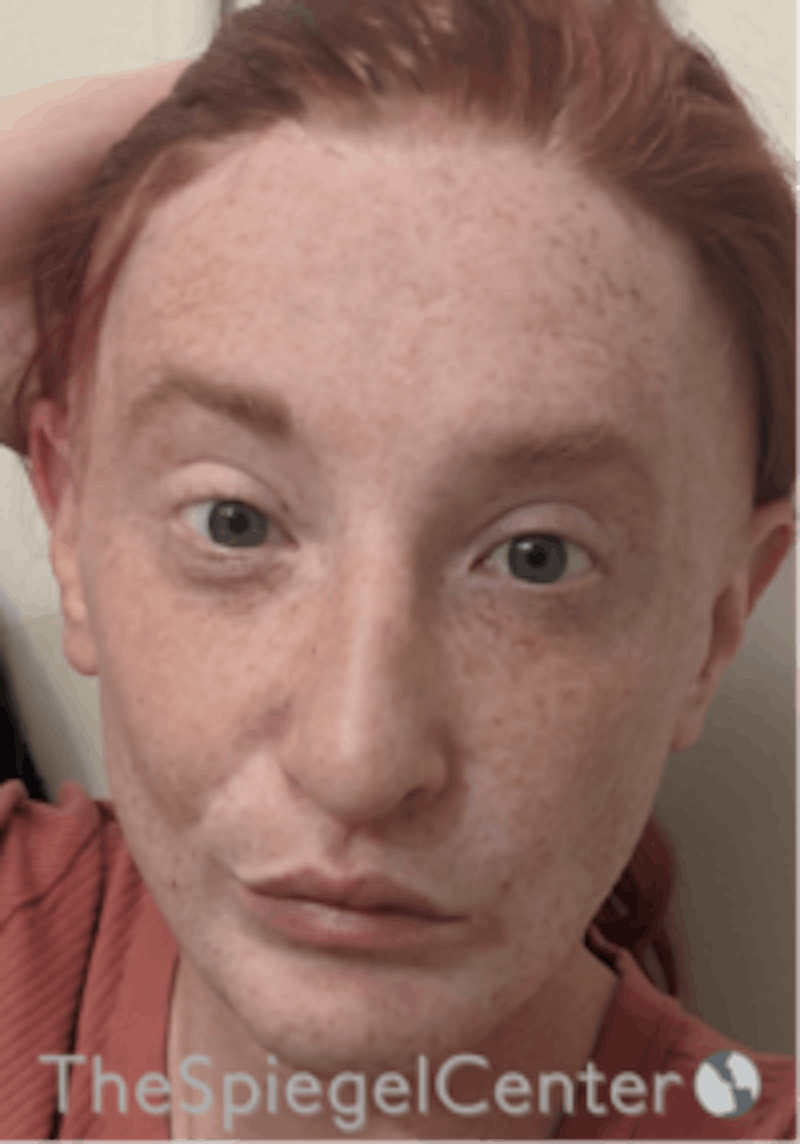 FFS Before & After Gallery - Patient 603948 - Image 2