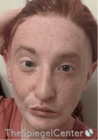 FFS Before & After Gallery - Patient 603948 - Image 2