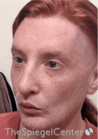 FFS Before & After Gallery - Patient 603948 - Image 4