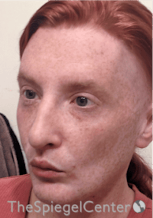 FFS Before & After Gallery - Patient 603948 - Image 4