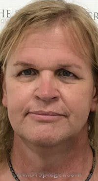 FFS Before & After Gallery - Patient 373758 - Image 1