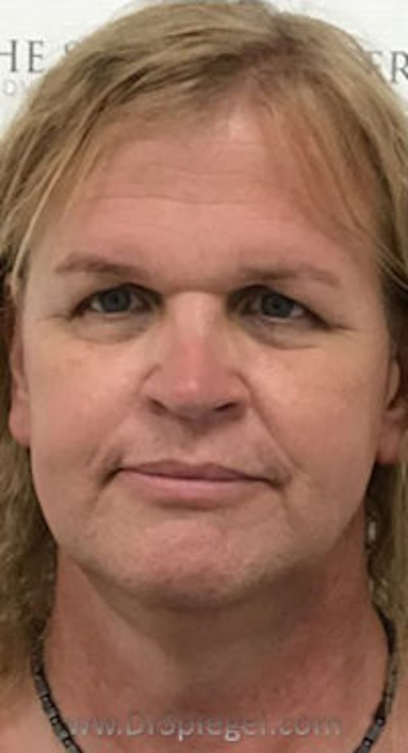 FFS Before & After Gallery - Patient 373758 - Image 1