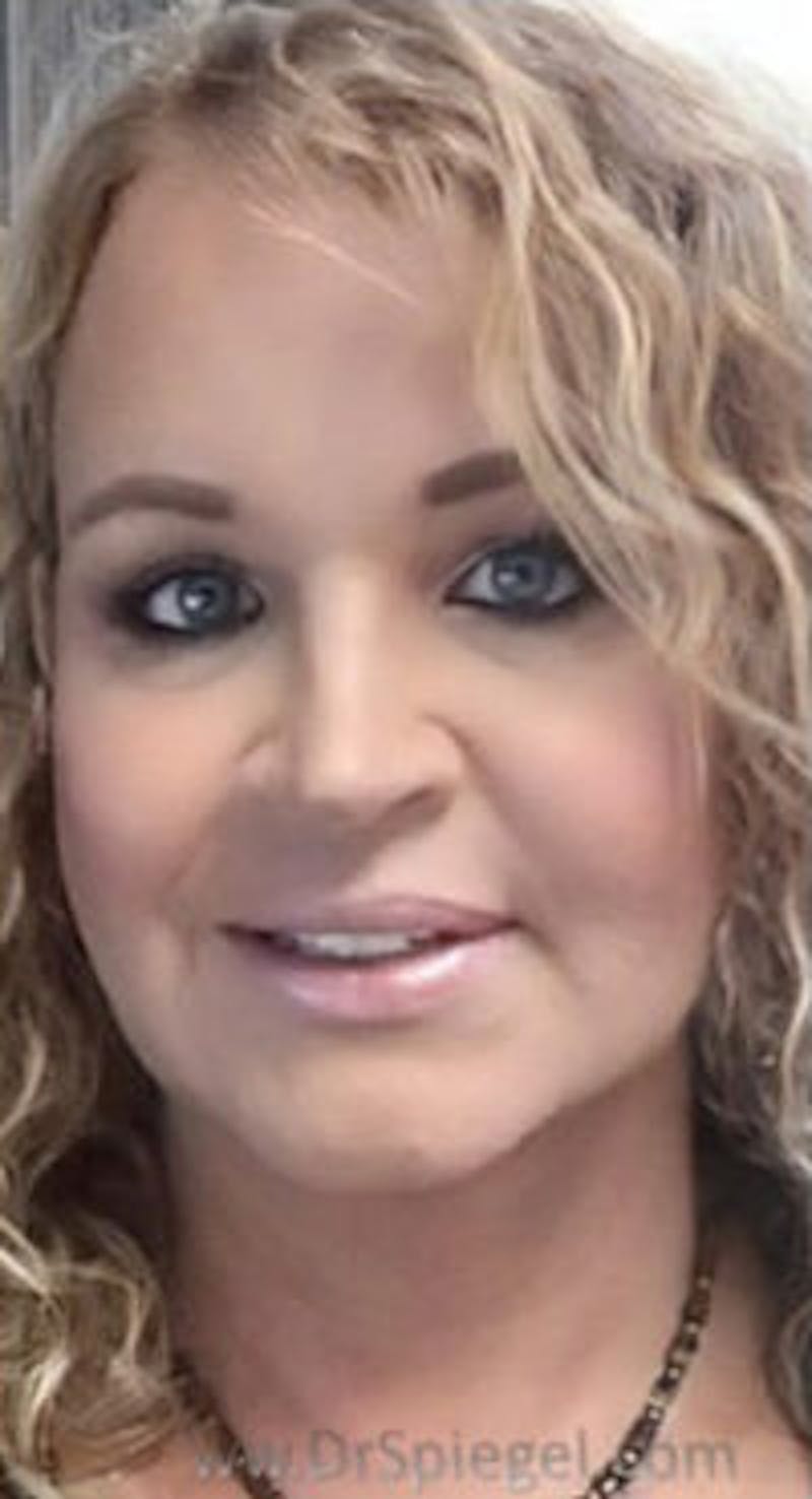 FFS Before & After Gallery - Patient 373758 - Image 2