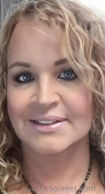 FFS Before & After Gallery - Patient 373758 - Image 2