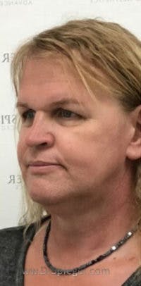 FFS Before & After Gallery - Patient 373758 - Image 3
