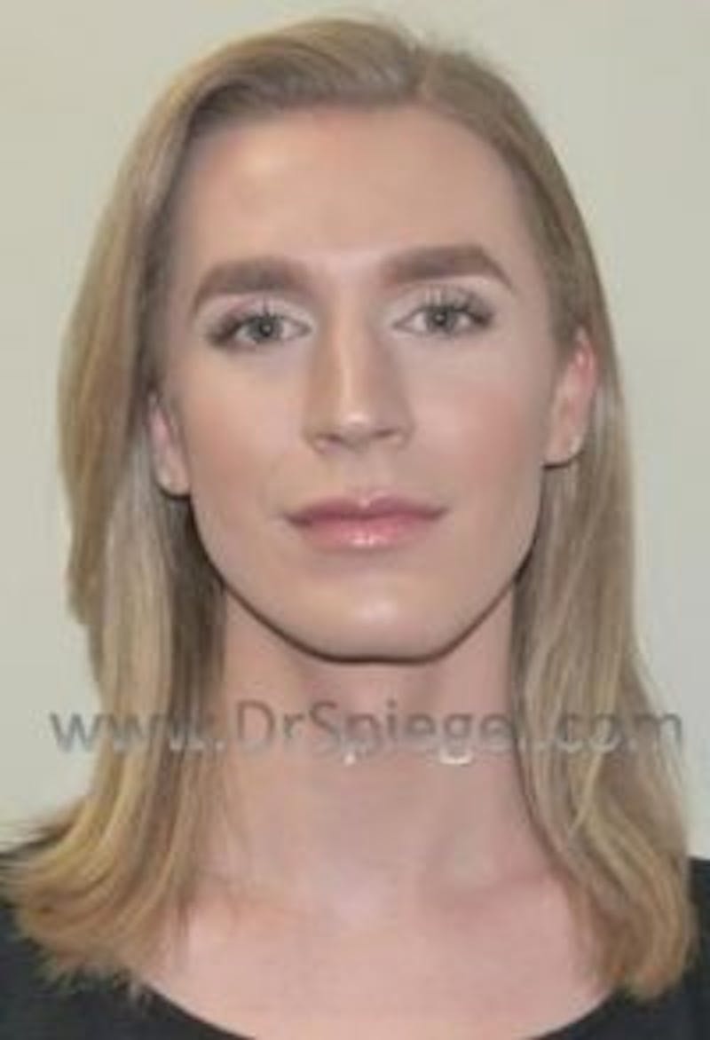 FFS Before & After Gallery - Patient 593670 - Image 1