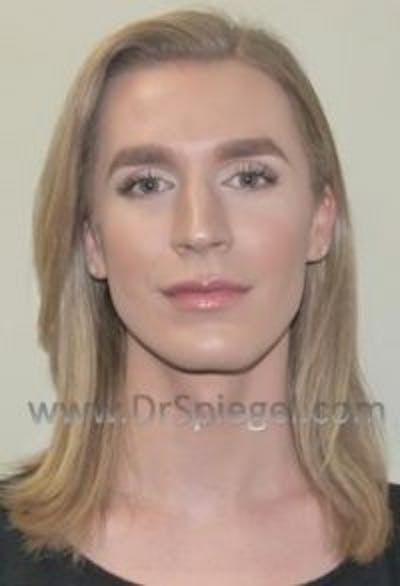 FFS Before & After Gallery - Patient 593670 - Image 1