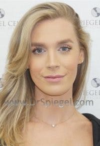 FFS Before & After Gallery - Patient 593670 - Image 2