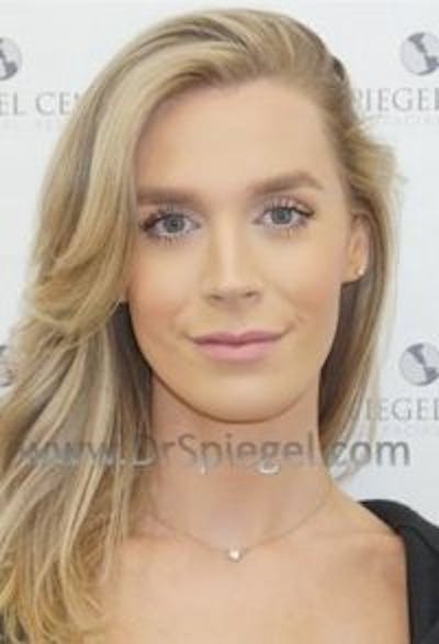 FFS Before & After Gallery - Patient 593670 - Image 2