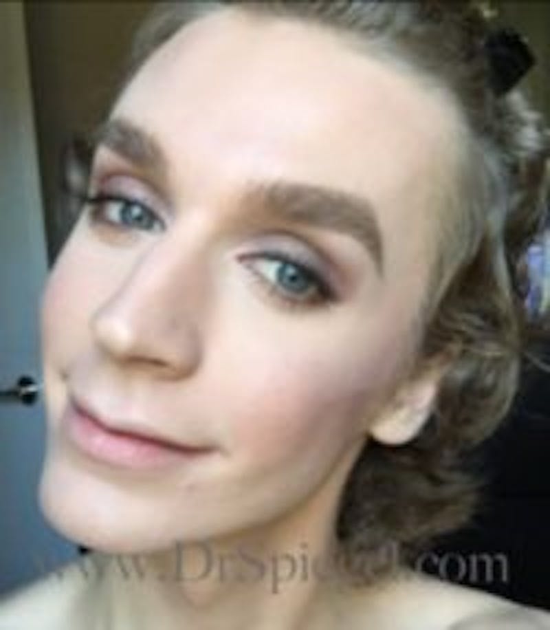 FFS Before & After Gallery - Patient 593670 - Image 3