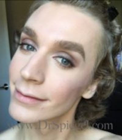 FFS Before & After Gallery - Patient 593670 - Image 3