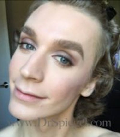 FFS Before & After Gallery - Patient 593670 - Image 3