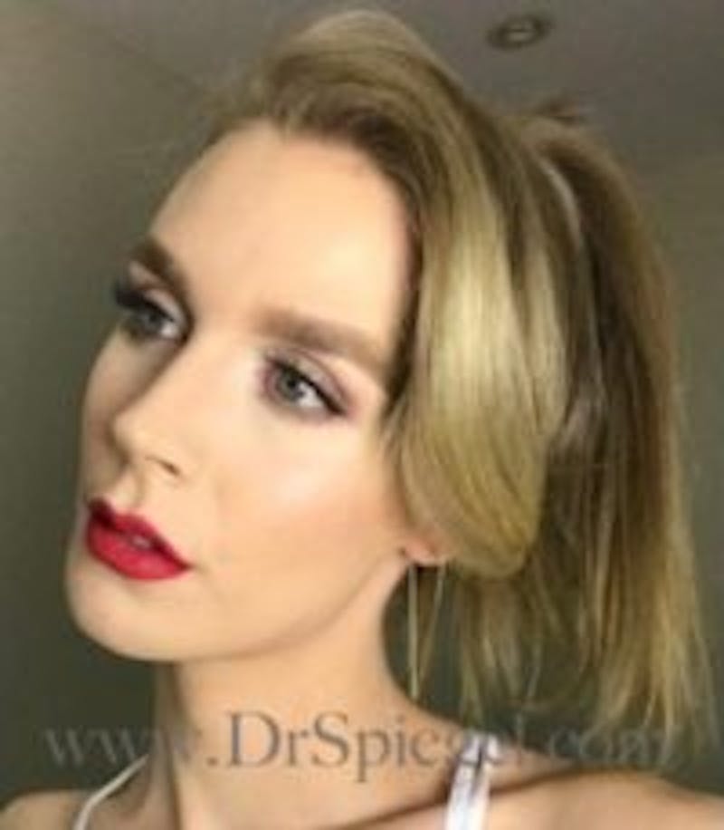 FFS Before & After Gallery - Patient 593670 - Image 4