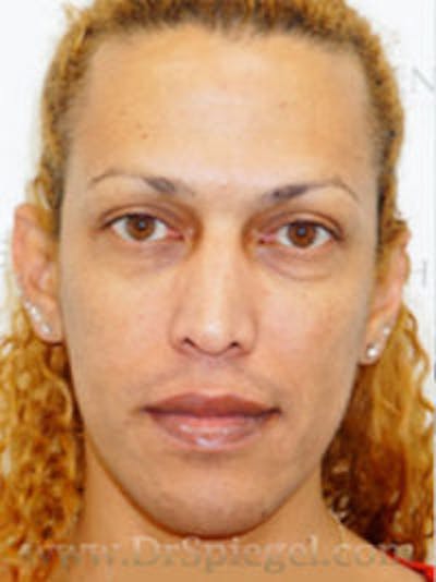 FFS Before & After Gallery - Patient 170363 - Image 1