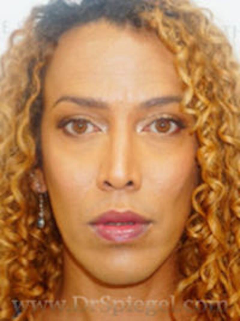 FFS Before & After Gallery - Patient 170363 - Image 2