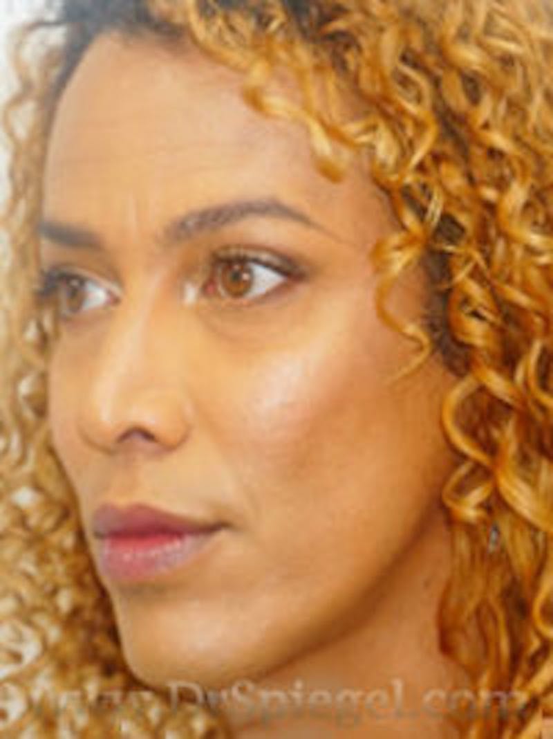 FFS Before & After Gallery - Patient 170363 - Image 4