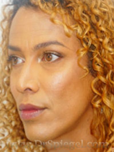 FFS Before & After Gallery - Patient 170363 - Image 4