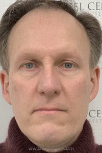 FFS Before & After Gallery - Patient 674914 - Image 1