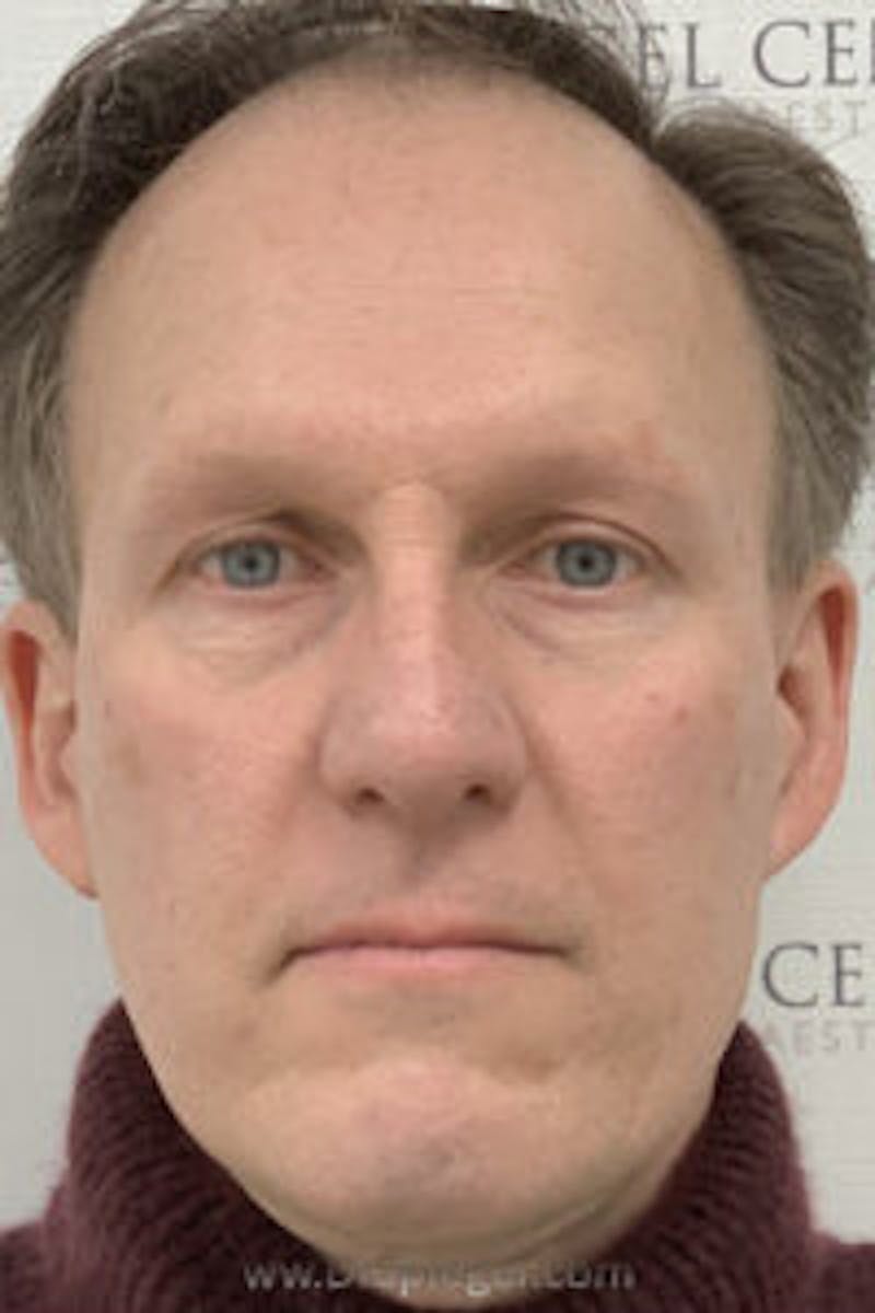 FFS Before & After Gallery - Patient 674914 - Image 1