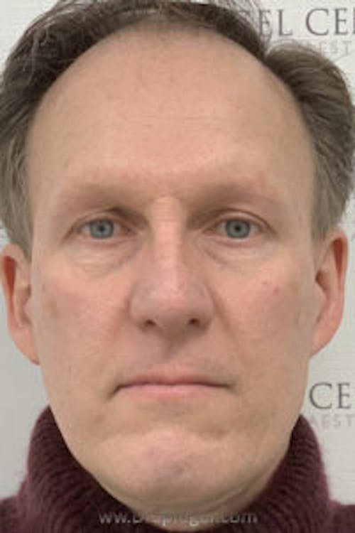 FFS Before & After Gallery - Patient 674914 - Image 1