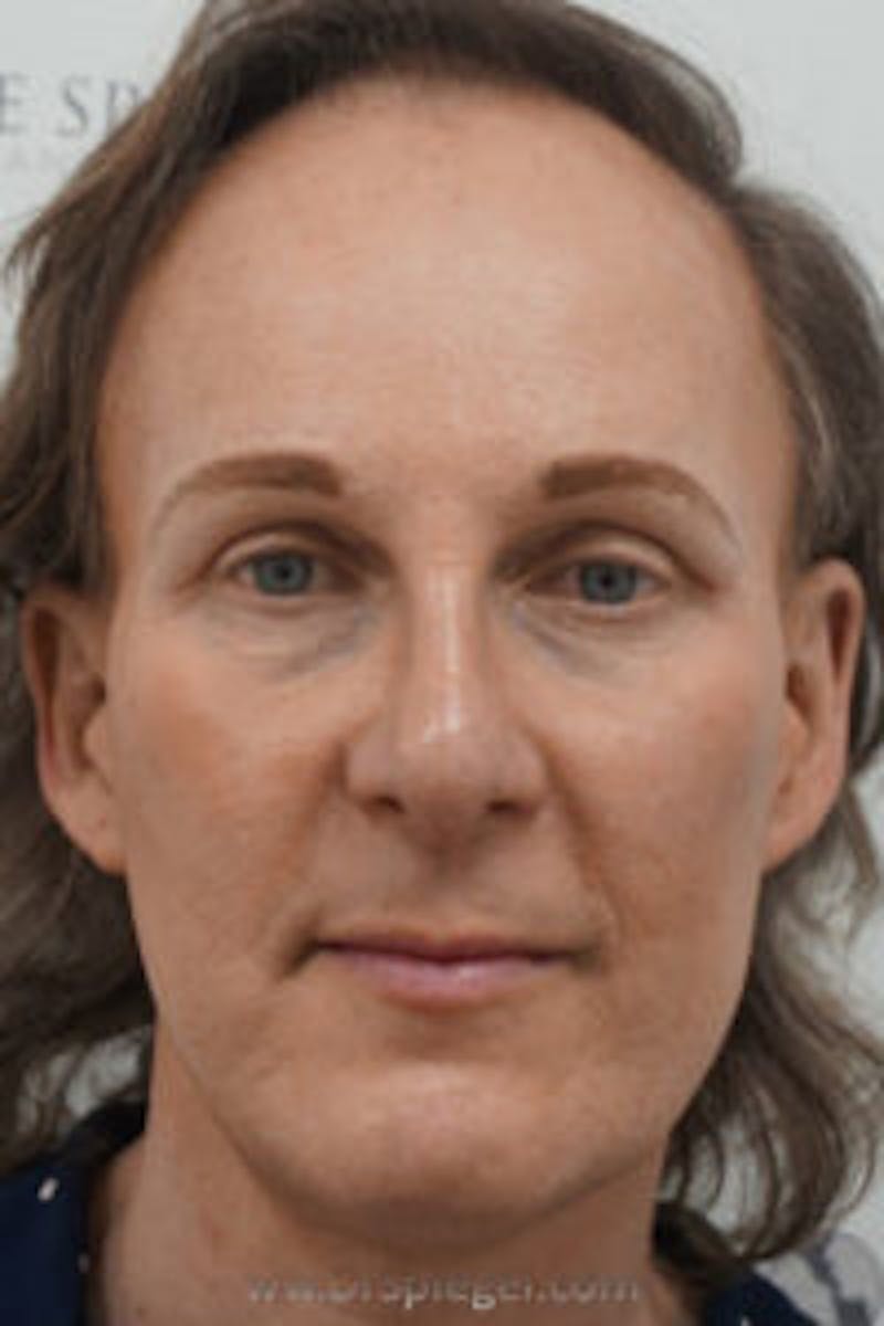 FFS Before & After Gallery - Patient 674914 - Image 2