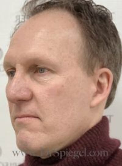 FFS Before & After Gallery - Patient 674914 - Image 3