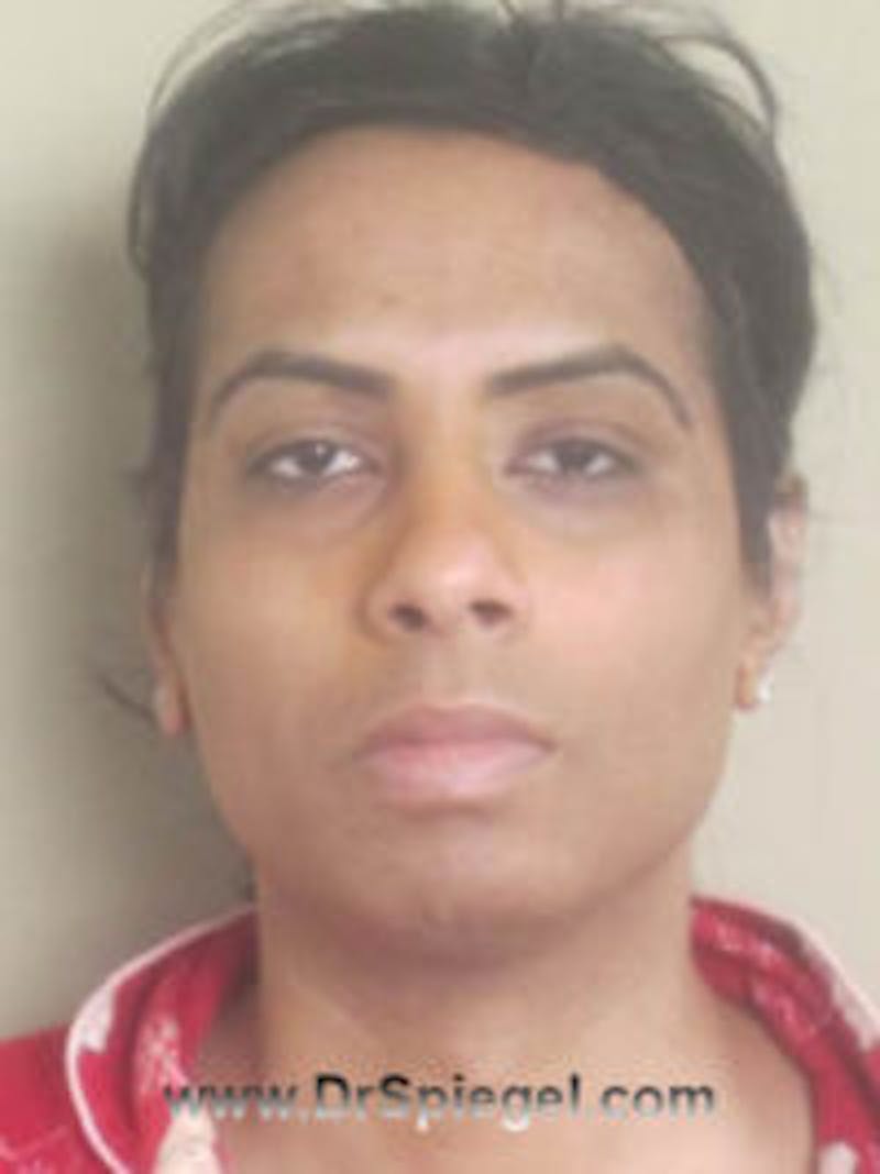 FFS Before & After Gallery - Patient 322962 - Image 1