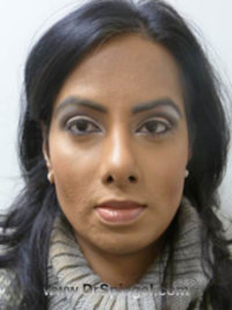 FFS Before & After Gallery - Patient 322962 - Image 2