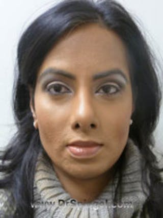 FFS Before & After Gallery - Patient 322962 - Image 2