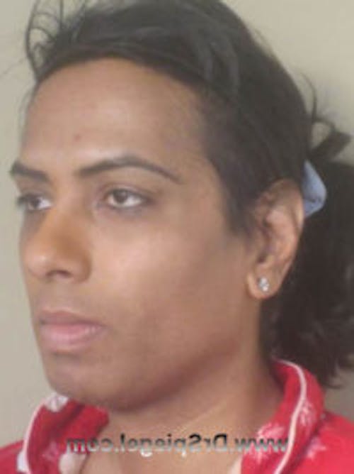 FFS Before & After Gallery - Patient 322962 - Image 3