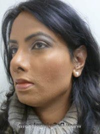 FFS Before & After Gallery - Patient 322962 - Image 4