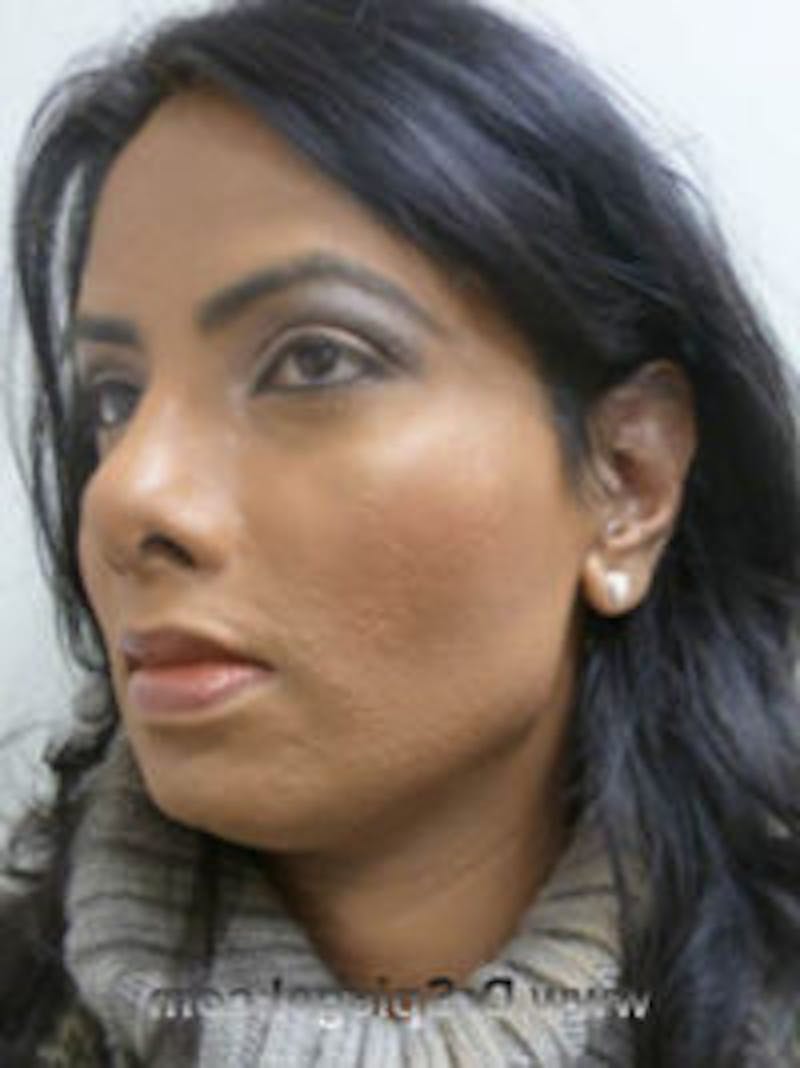 FFS Before & After Gallery - Patient 322962 - Image 4