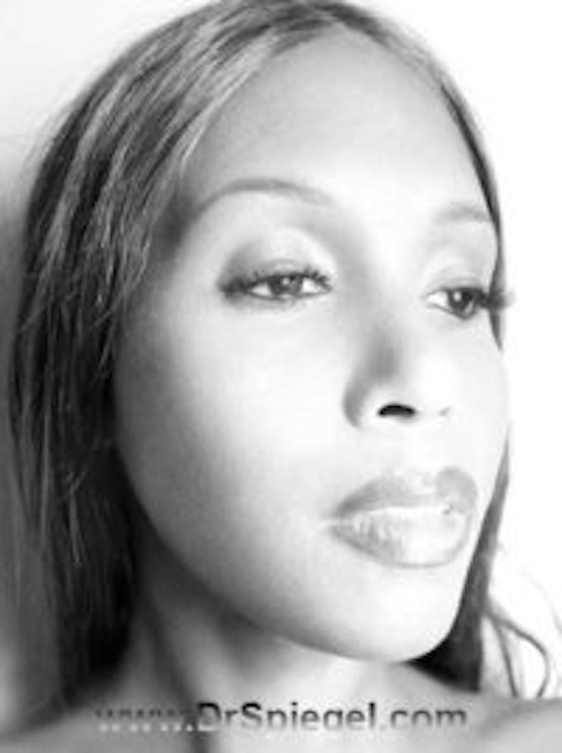 FFS Before & After Gallery - Patient 139953 - Image 2