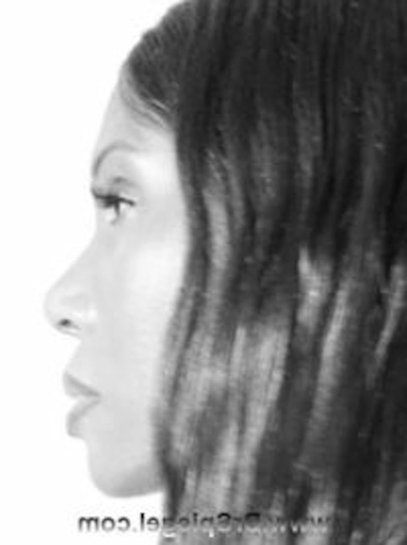 FFS Before & After Gallery - Patient 139953 - Image 4