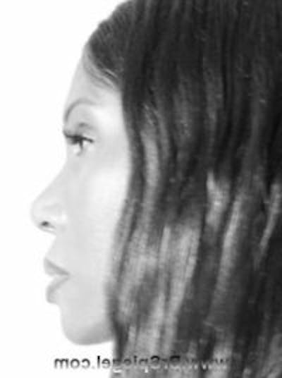 FFS Before & After Gallery - Patient 139953 - Image 4