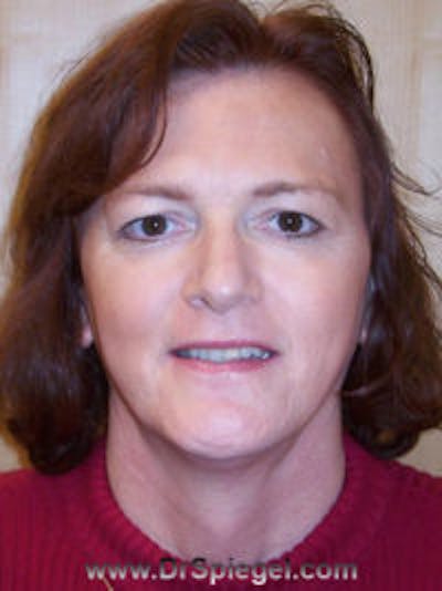 FFS Before & After Gallery - Patient 395826 - Image 1