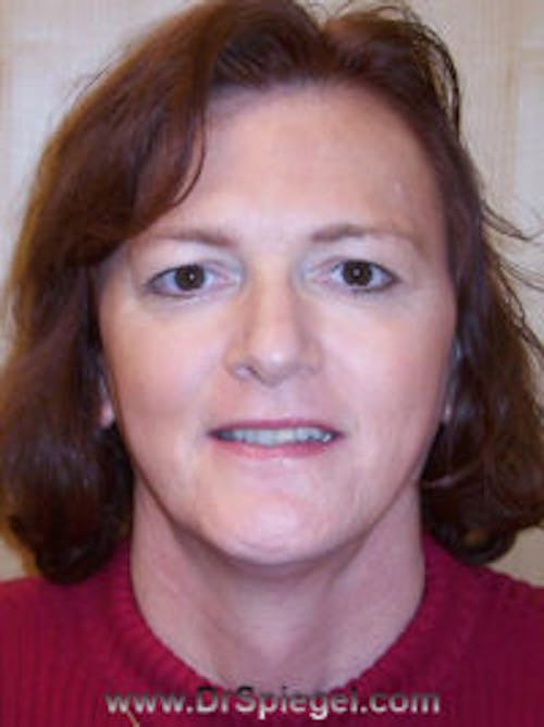 FFS Before & After Gallery - Patient 395826 - Image 1