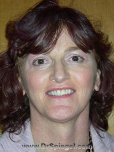 FFS Before & After Gallery - Patient 395826 - Image 2