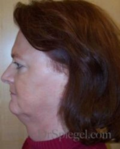 FFS Before & After Gallery - Patient 395826 - Image 3