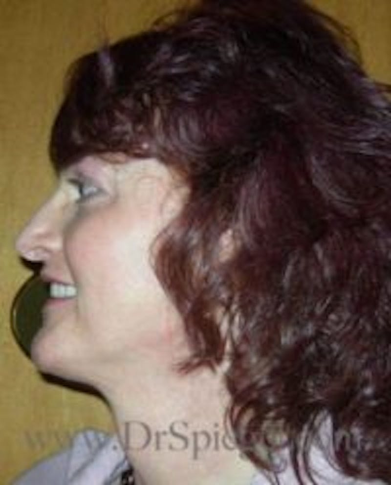 FFS Before & After Gallery - Patient 395826 - Image 4