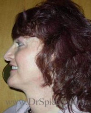 FFS Before & After Gallery - Patient 395826 - Image 4
