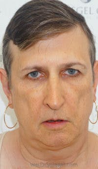 FFS Before & After Gallery - Patient 179405 - Image 1
