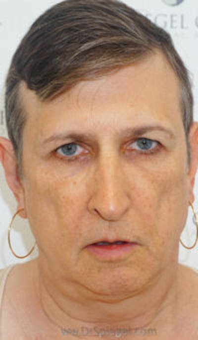 FFS Before & After Gallery - Patient 179405 - Image 1