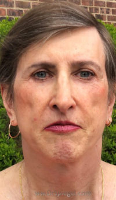 FFS Before & After Gallery - Patient 179405 - Image 2