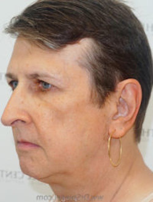 FFS Before & After Gallery - Patient 179405 - Image 3