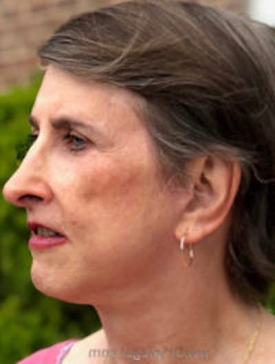 FFS Before & After Gallery - Patient 179405 - Image 4