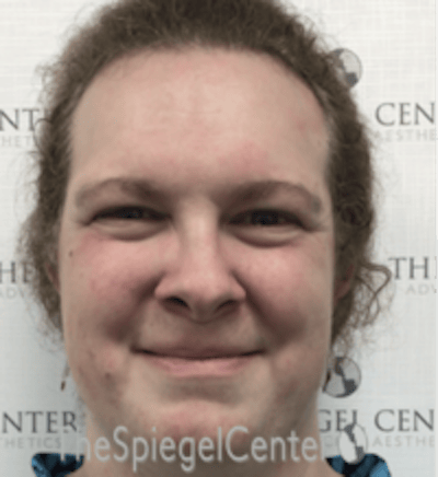 FFS Before & After Gallery - Patient 615340 - Image 1