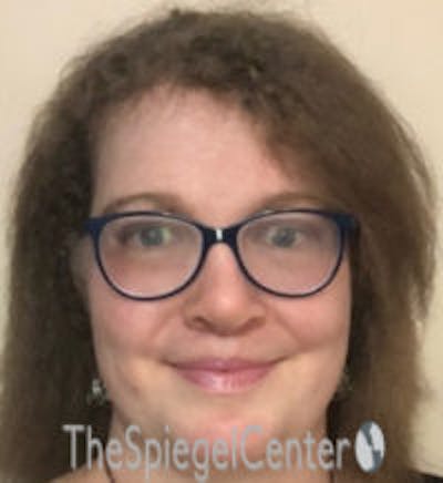 FFS Before & After Gallery - Patient 615340 - Image 2