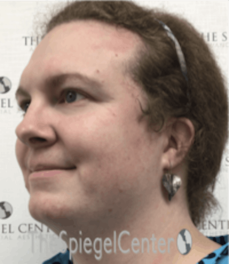 FFS Before & After Gallery - Patient 615340 - Image 3