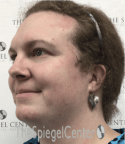 FFS Before & After Gallery - Patient 615340 - Image 3